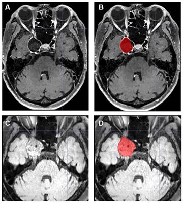 Predictors of aneurysm shrinkage after flow diversion treatment for internal carotid artery aneurysms: quantitative volume analysis with MRI